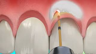 Dental Treatment  Osseous Crown Lengthening with Waterlase Laser Dentistry [upl. by Melena]