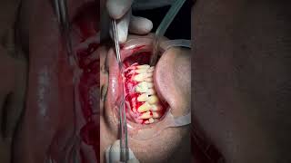 Removing of Large periapical cyst and granuloma  ازاله كيس دهني بالفك dentist doctorsaleemplastic [upl. by Docila807]