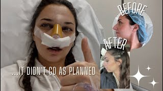 I got a nose job in secret and vlogged the process [upl. by Sal]