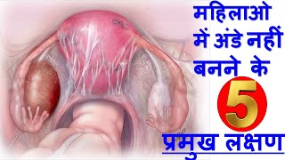 महिलाओ में अंडे नहीं बनने के 5 प्रमुख लक्षण व कारण Anovulatory cycle symptoms amp Reason In Hindi [upl. by Lubet]