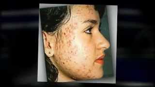 Best Product to Remove Acne Scars  Acne Treatment Products [upl. by Rosemarie]