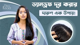 Salicylic acid for dandruff treatment ড্যানড্রফ দূর করতে স্যালিসাইলিক এসিড [upl. by Gaylor]