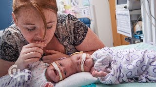 Conjoined Twins Abby and Erin Delaney A Year in the Life [upl. by Inaffets]