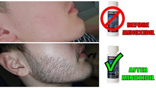 I Grew Out My Beard For 3 Months Using Minoxidil Rogaine [upl. by Ahkeber244]