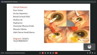 Early and late postoperative complication of cataract surgery Dr Pranav Patil 04 June 2021 [upl. by Anelhtak63]