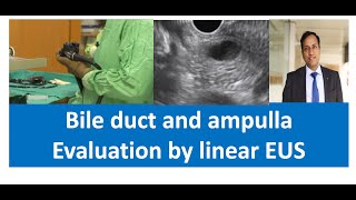 Linear EUS anatomy Evaluation of Common bile duct and ampulla  Dr Vikas Singla [upl. by Athiste]