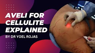 AVELI FOR CELLULITE EXPLAINED BY DR YOEL ROJAS [upl. by Senoj]