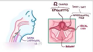 laryngomalacia [upl. by Farika]