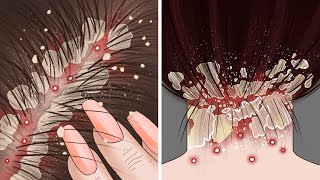 ASMR Oddly Satisfying Dandruff Scratching Process [upl. by Ligetti750]