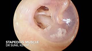 Glimpses of Stapedius Muscle and Stapes Bone  Otoendoscopy  Dr Sunil Kewat [upl. by Llenrahc]