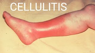 Cellulitis Skin InfectionCellulitisCauses SymptomsDiagnosisTreatmentPrevention Complications [upl. by Aharon]