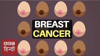 How To Recognise 12 Symptoms of Breast Cancer  BBC Duniya [upl. by Balough57]