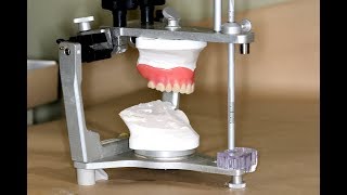 Clinical Remount of Complete Dentures [upl. by Derry]