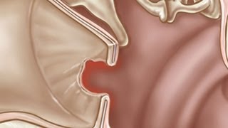 How to Treat a Perforated Ear Drum  Ear Problems [upl. by Anifares]