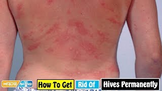 How to Get Rid of Hives Permanently  Home Remedies For Hives Symptoms [upl. by Llabmik]