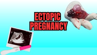 Ectopic Pregnancy  Causes Symptoms And Risks [upl. by Notxam]