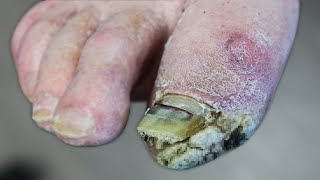 WHATS GROWING ON HIS FOOT THICK SKIN OR FUNGUS [upl. by Hurwitz]