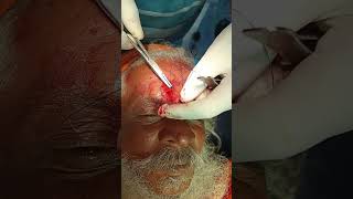 Forehead Cyst removal done under LA and suturing done with 20 vicryl kant eye care optometrist [upl. by Ilatan]