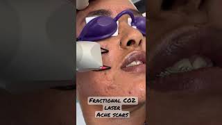 Acne and Acne scars treatment FractionalCO2 laser fractionalcolaser olimpiacarmen [upl. by Ahsratal]