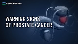 10 Warning Signs of Prostate Cancer [upl. by Ruprecht620]