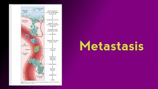 Tumour pathology2  Invasion and Metastasis [upl. by Ier]