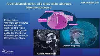 Quiste aracnoideo silla turca vacia cirugia neuroendoscopica [upl. by Zavala793]