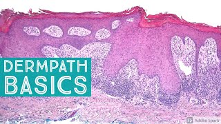 Basic Dermpath Cases  Explained by a Dermatopathologist [upl. by Reina]