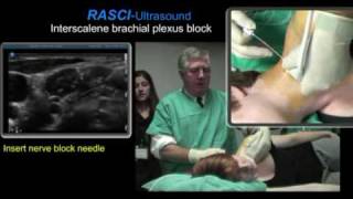 Ultrasound guided interscalene brachial plexus block [upl. by Ado]