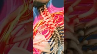 Cervical Herniated Disc [upl. by Anastasia]