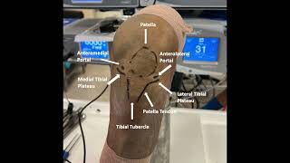 In Office Needle Arthroscopy of the Knee With Lateral Parapatellar Retinacular Release [upl. by Eyar993]