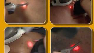 Laser Hair Removal video by Cynosure [upl. by Annunciata]