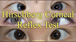 Hirschberg Corneal Reflex Test Principles and Procedure [upl. by Kariotta941]