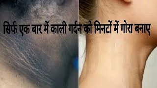 Skin Bleaching काली गर्दन को मिनटों में गोरा सुंदर बनाये  dark neck to fair [upl. by Emilie]