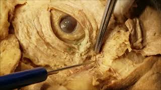 Diagnostics and treatment of lacrimal duct obstruction in the Ophthalmology Clinic of MC Nairi [upl. by Tony591]