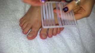 How to treat TOENAILS FUNGUS [upl. by Jestude719]