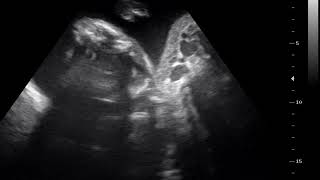 interesting case 467 ultrasound 2D 3D 4D acardiac twin [upl. by Lenrad]