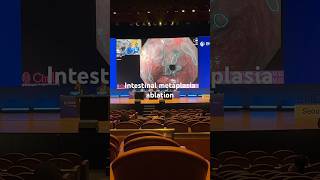 Intestinal metaplasia ablation ENDO2024 [upl. by Reviere]