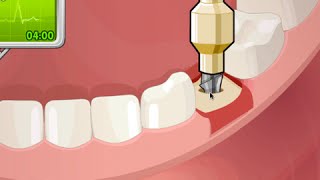 Single Dental Implant Procedure Animated [upl. by Aicenet]