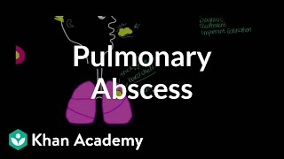 Pulmonary abscess  Respiratory system diseases  NCLEXRN  Khan Academy [upl. by Byrdie]