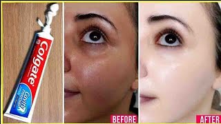 Apply Toothpaste on Your Skin and See Magical Result within 1 Hour  Amazing Toothpaste Beauty Hacks [upl. by Hemetaf667]