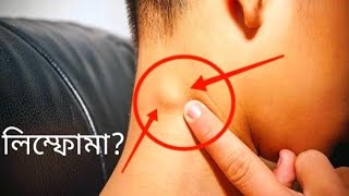 লিম্ফোমাLymphomaCauses symptoms diagnosis Treatment doctorjoydeb [upl. by Morice]