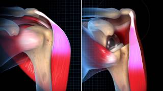 Biomechanical Summary of Reverse Shoulder Arthroplasty [upl. by Yerag121]