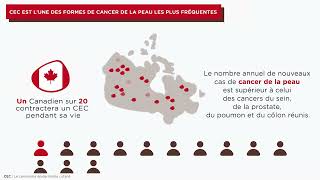 Mieux Comprendre le Carcinome épidermoïde Cutané CEC [upl. by Noreen238]