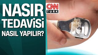 Nasır tedavisi nasıl yapılır [upl. by Bauer]