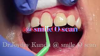 Midline diastema closure esthetic Direct composite veneers [upl. by Reyotal72]