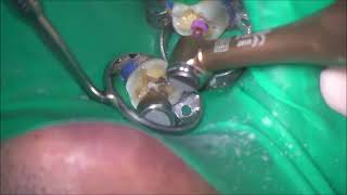 ProTaper Gold in outstroke brushing motion [upl. by Atilal]