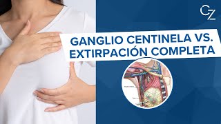 Ganglio Centinela vs Extirpación Completa [upl. by Cofsky451]