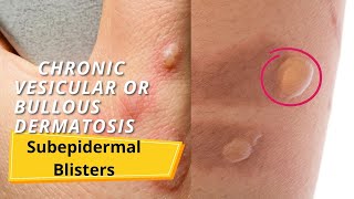 Subepidermal Blisters [upl. by Ted]