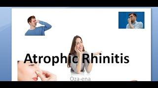 ENT Atrophic Rhinitis Ozaena Merciful anosmia Klebsiella Kemicetine Oestradiol young operation KI [upl. by Annyl]