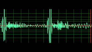 Mitral Regurgitation slow [upl. by Enilesoj]